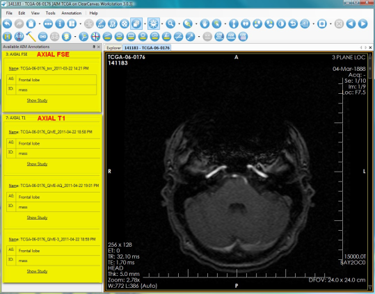 AIM annotations for an imaging study