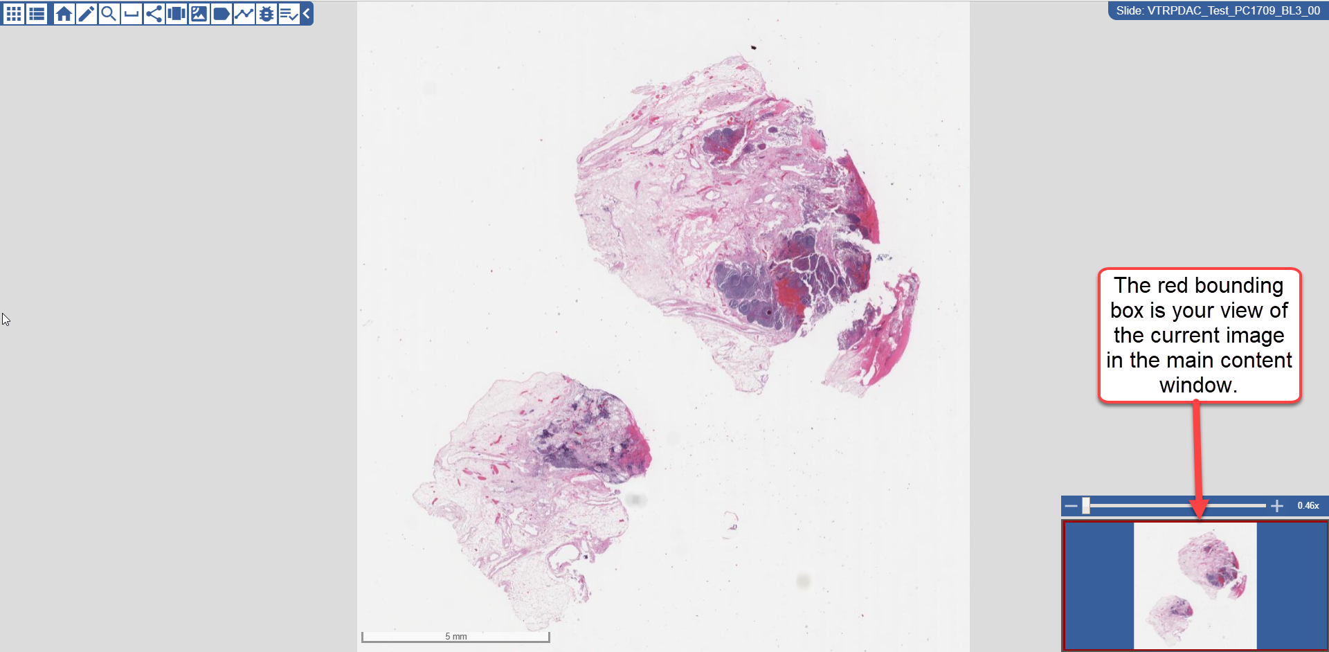 Image of slide in caMicroscope showing a breast cancer image in the main content window and an inset window that shows the same image with a red box around it, indicating that the full slide image is being shown in the main content window.